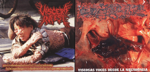 Viscera Infest : Paracoccidioidomicosisproctitissarcomucosis - Viscera Infest